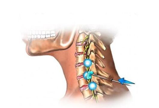 emakakaela osteokondroosi ravi